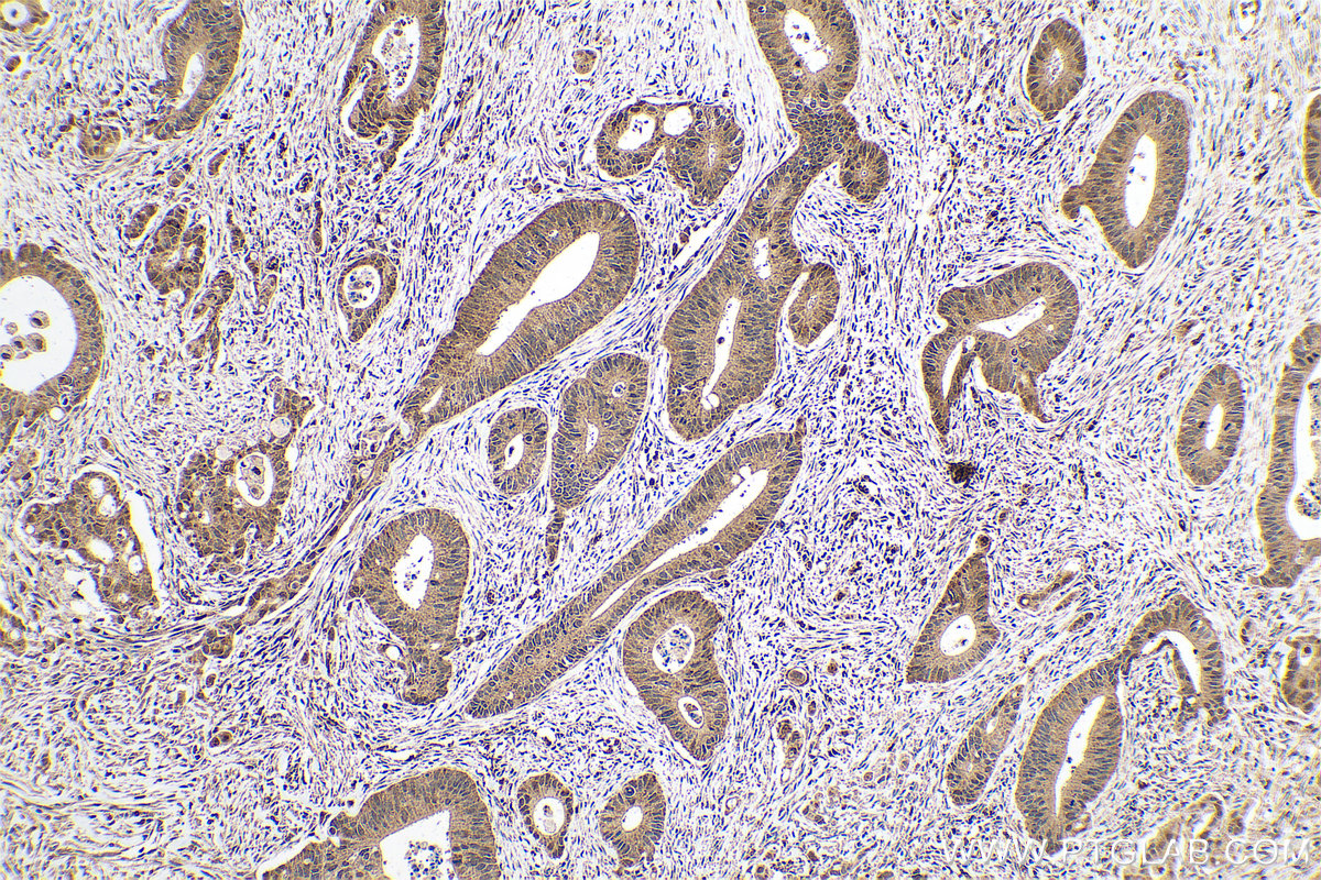 Immunohistochemical analysis of paraffin-embedded human colon cancer tissue slide using KHC0759 (MCC IHC Kit).