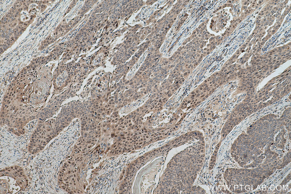 Immunohistochemical analysis of paraffin-embedded human oesophagus cancer tissue slide using KHC0759 (MCC IHC Kit).