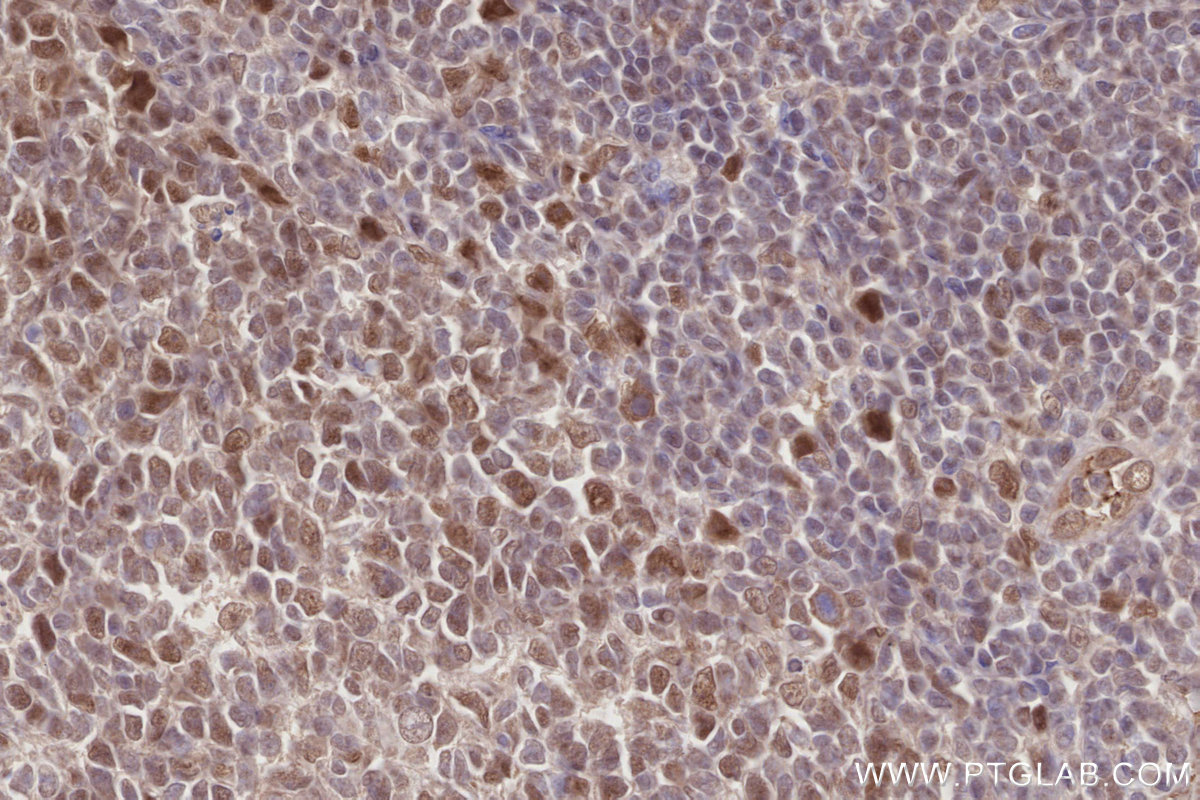 Immunohistochemical analysis of paraffin-embedded human tonsillitis tissue slide using KHC2867 (MCM-BP IHC Kit).