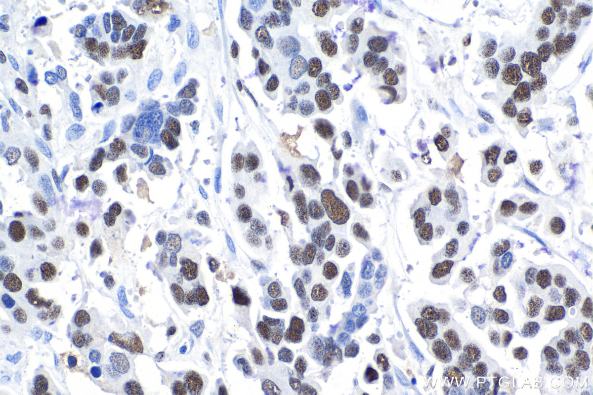 Immunohistochemical analysis of paraffin-embedded human colon cancer tissue slide using KHC1028 (MCM4 IHC Kit).