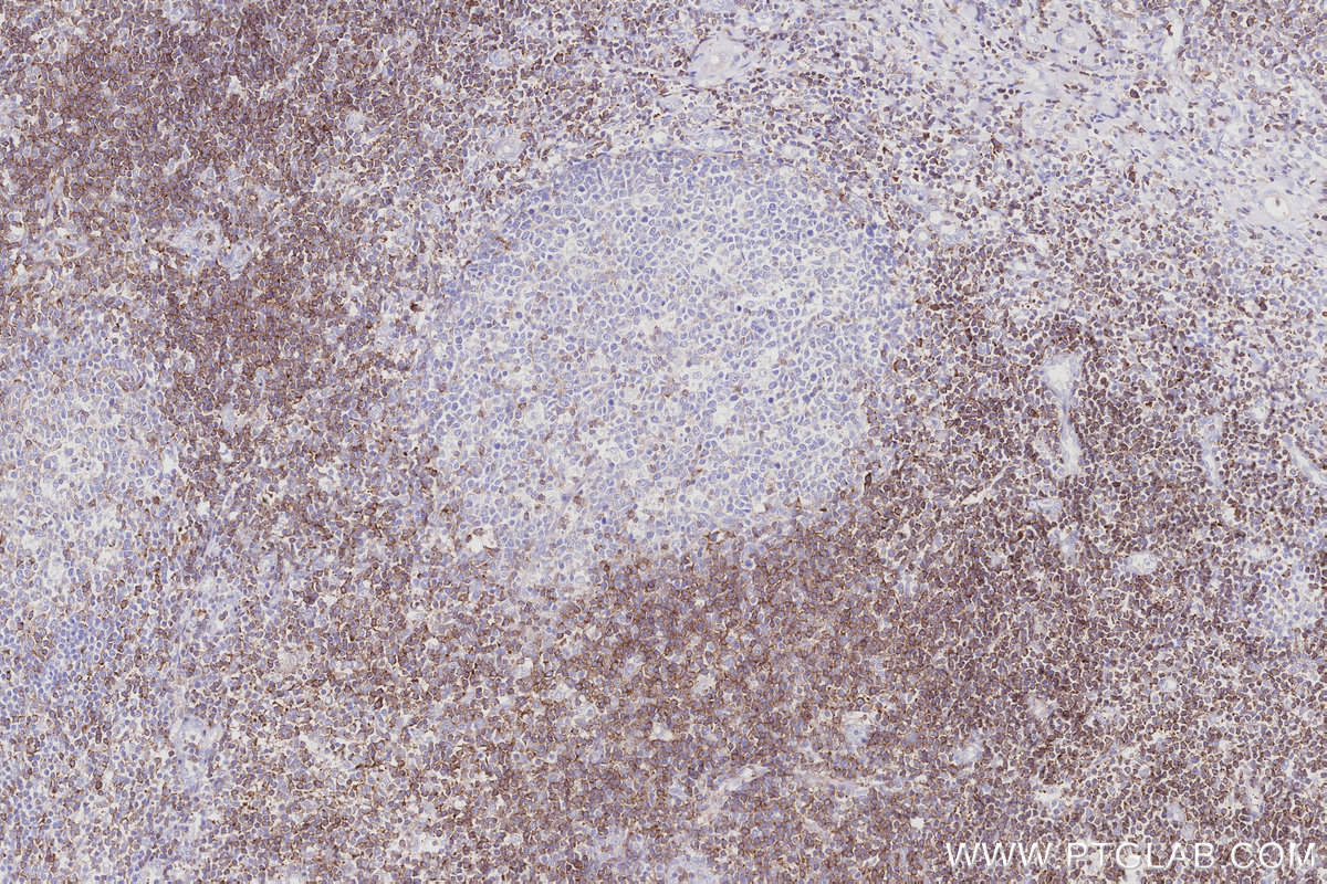Immunohistochemical analysis of paraffin-embedded human tonsillitis tissue slide using KHC3032 (MCTS1 IHC Kit). Immunohistochemical analysis of paraffin-embedded human tonsillitis tissue slide using KHC3032 (MCTS1 IHC Kit).