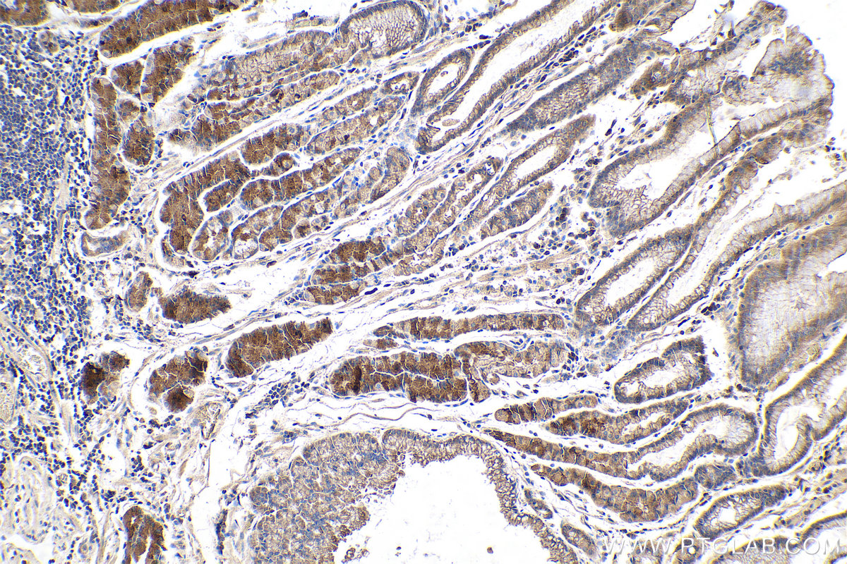 Immunohistochemical analysis of paraffin-embedded human stomach cancer tissue slide using KHC0213 (Midkine IHC Kit).