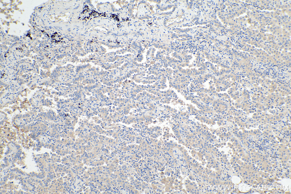 Immunohistochemical analysis of paraffin-embedded human lung cancer tissue slide using KHC0213 (Midkine IHC Kit).