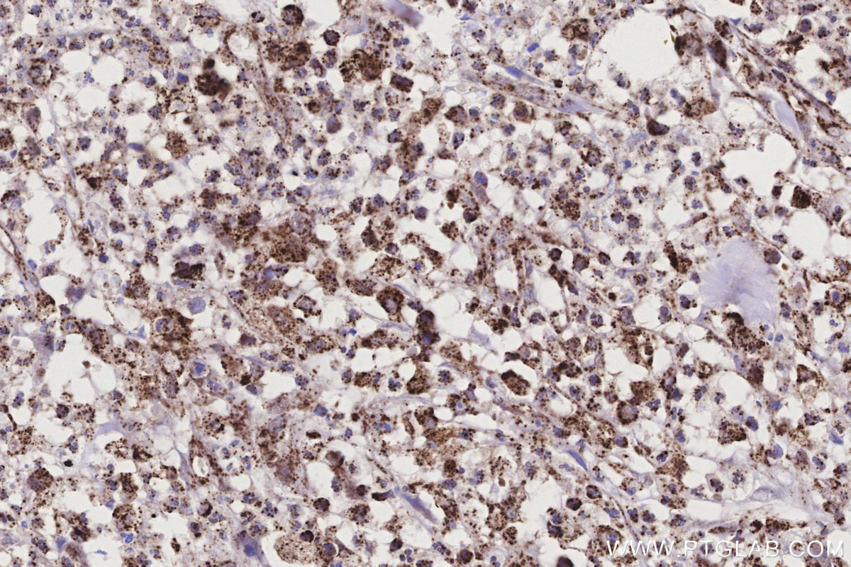 Immunohistochemical analysis of paraffin-embedded human colon cancer tissue slide using KHC3199 (ME2 IHC Kit).