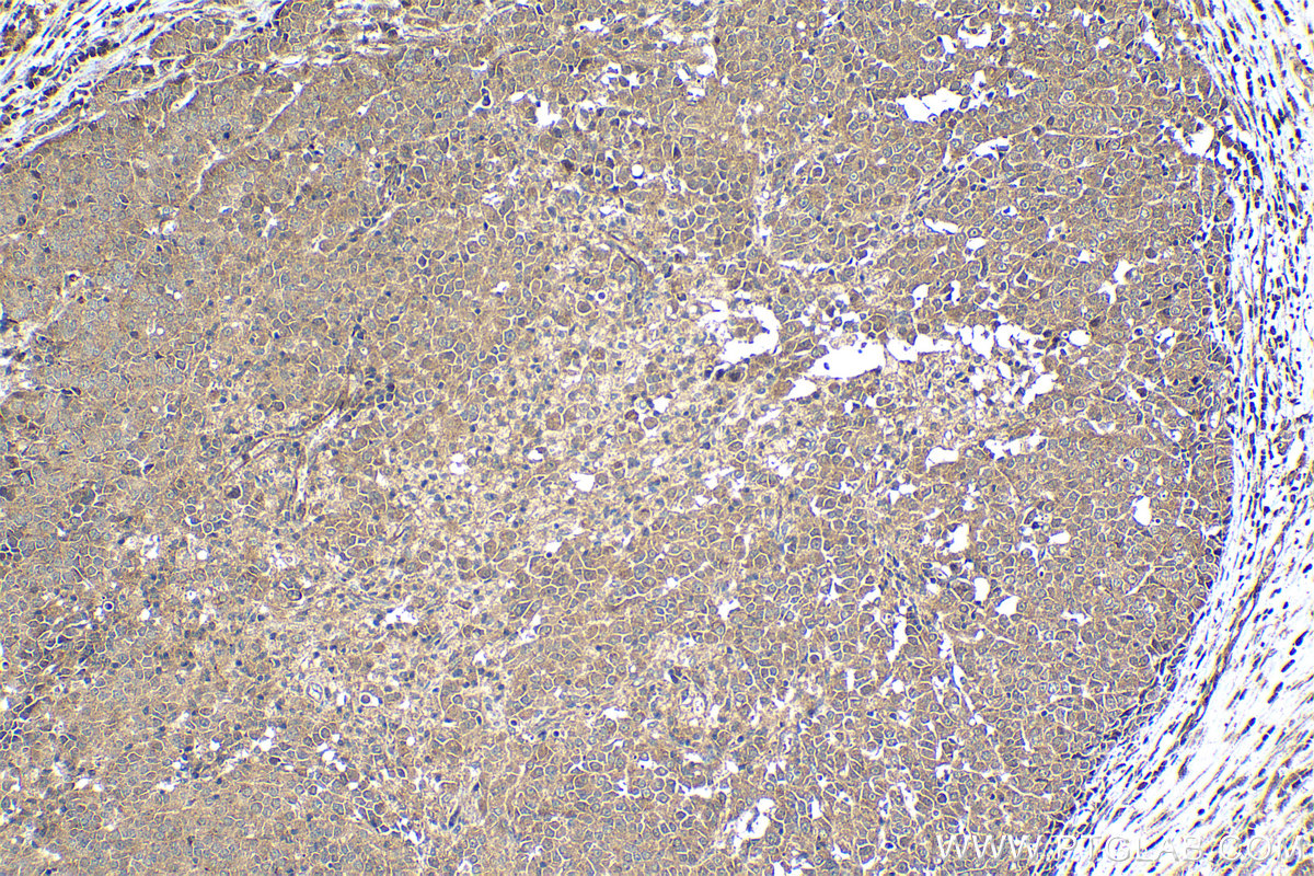 Immunohistochemical analysis of paraffin-embedded human ovary tumor tissue slide using KHC1261 (MEI1 IHC Kit).