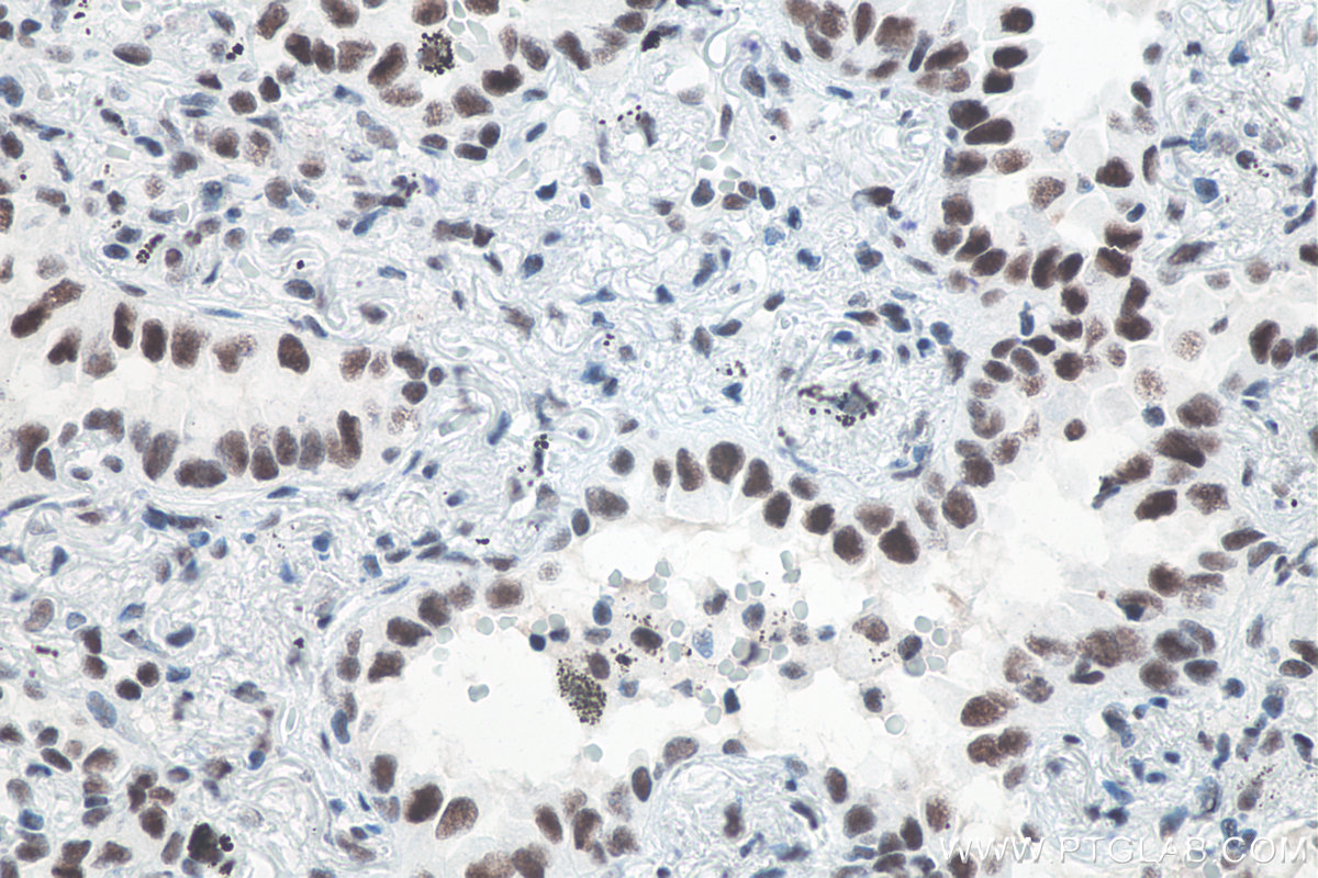 Immunohistochemical analysis of paraffin-embedded human lung cancer tissue slide using KHC0061 (METTL3 IHC Kit).