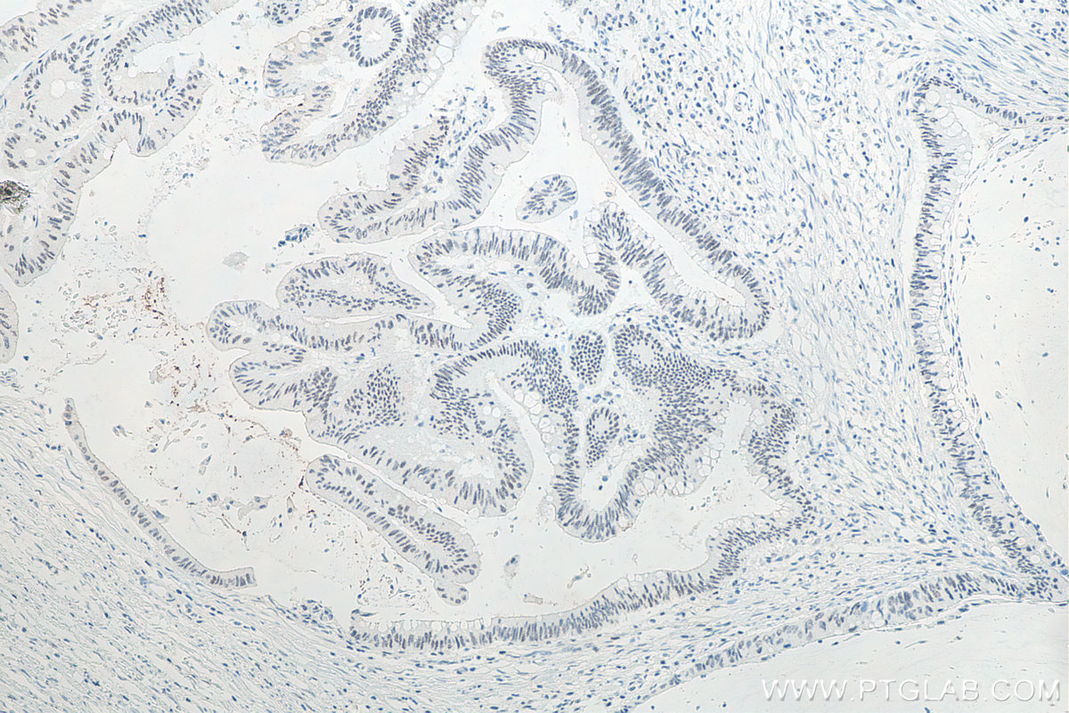 Immunohistochemical analysis of paraffin-embedded human colon cancer tissue slide using KHC0061 (METTL3 IHC Kit).