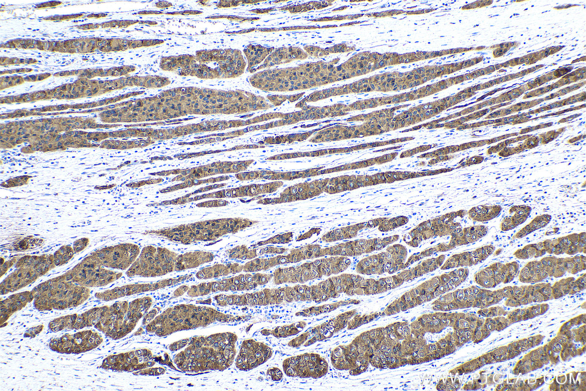 Immunohistochemical analysis of paraffin-embedded human liver cancer tissue slide using KHC0532 (METTL7A IHC Kit).