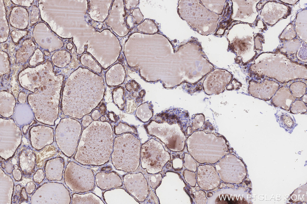 Immunohistochemical analysis of paraffin-embedded human thyroid cancer tissue slide using KHC3248 (MGAT2 IHC Kit).