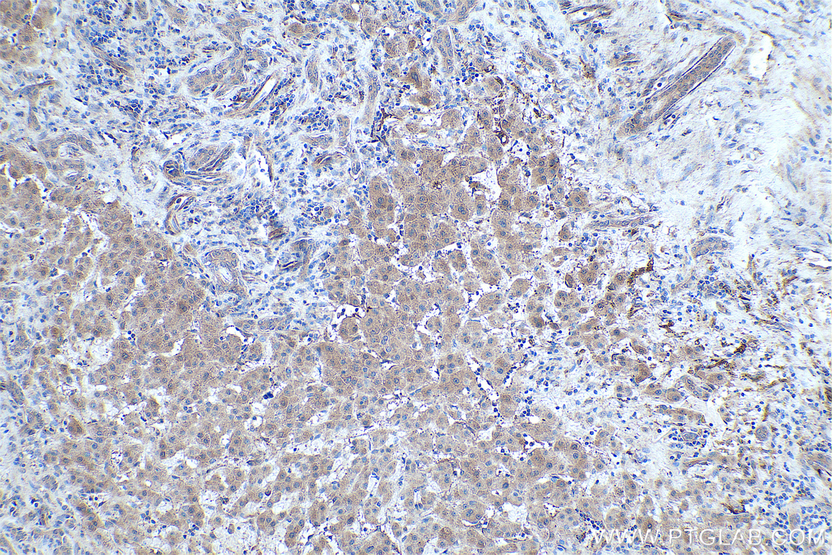 Immunohistochemical analysis of paraffin-embedded human liver cancer tissue slide using KHC0435 (MGLL IHC Kit).