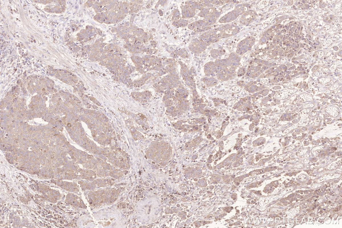 Immunohistochemical analysis of paraffin-embedded human stomach cancer tissue slide using KHC3277 (MIGA2/FAM73B IHC Kit). Immunohistochemical analysis of paraffin-embedded human stomach cancer tissue slide using KHC3277 (MIGA2/FAM73B IHC Kit).