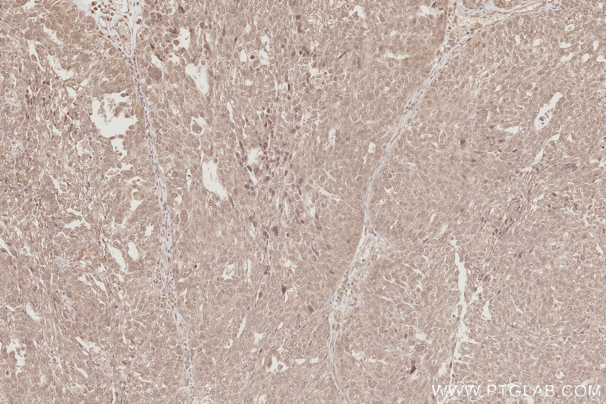 Immunohistochemical analysis of paraffin-embedded human ovary cancer tissue slide using KHC2898 (MIS12 IHC Kit).
