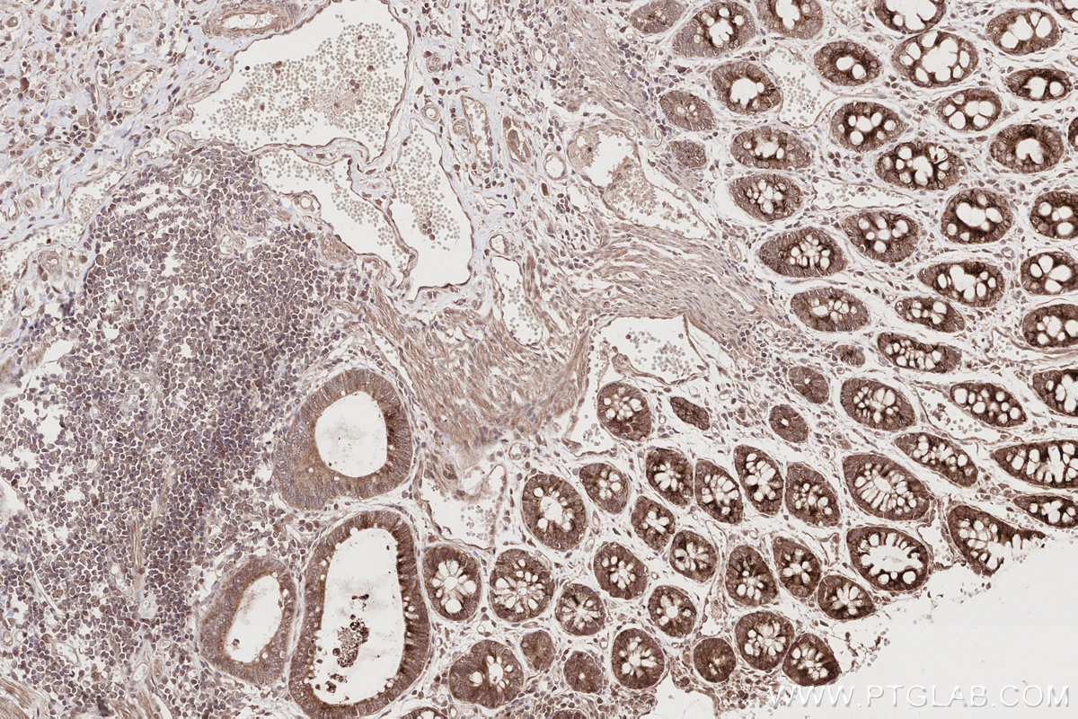 Immunohistochemical analysis of paraffin-embedded human rectal cancer tissue slide using KHC2734 (MITD1 IHC Kit).