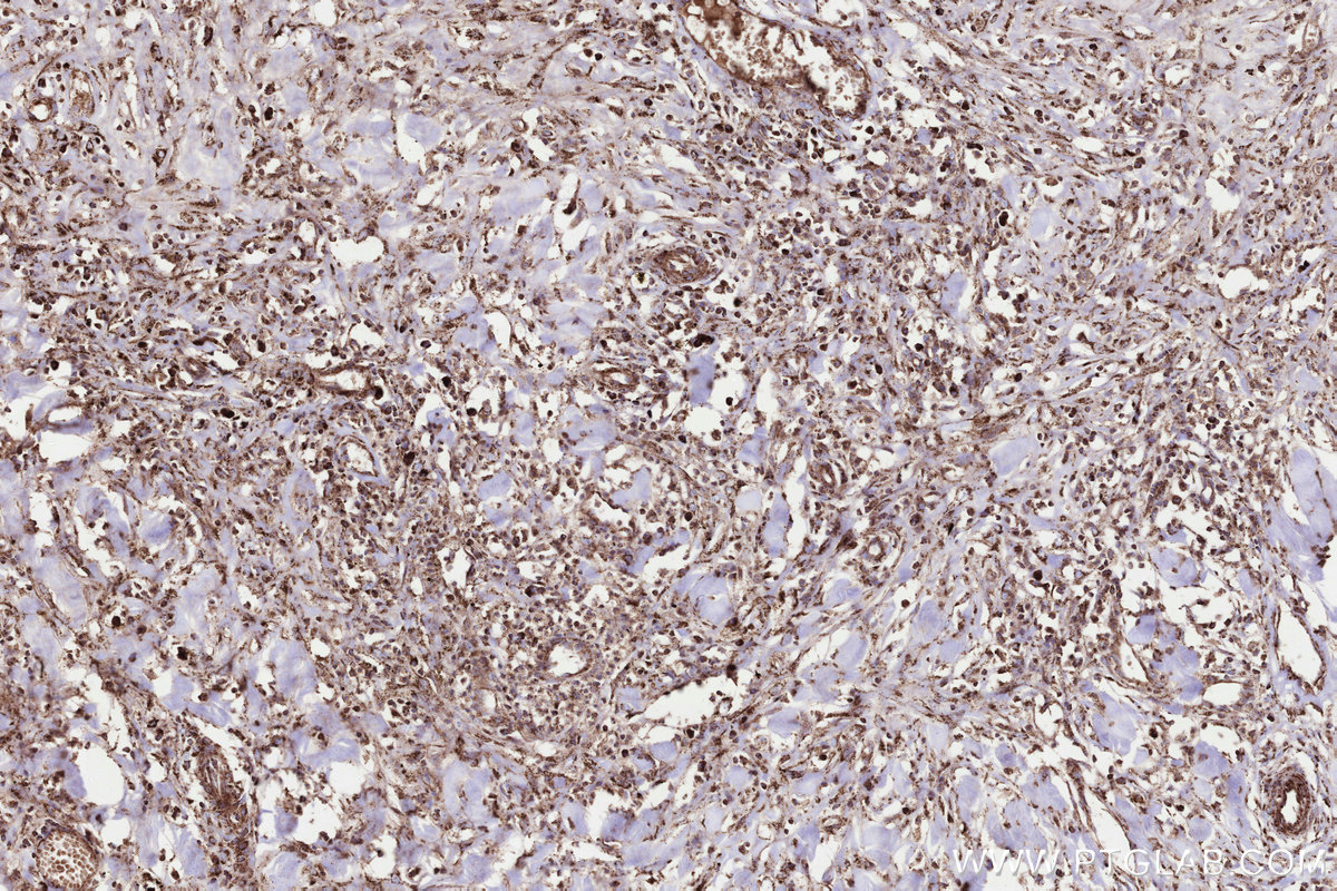 Immunohistochemical analysis of paraffin-embedded human colon cancer tissue slide using KHC3289 (MMGT1 IHC Kit).
