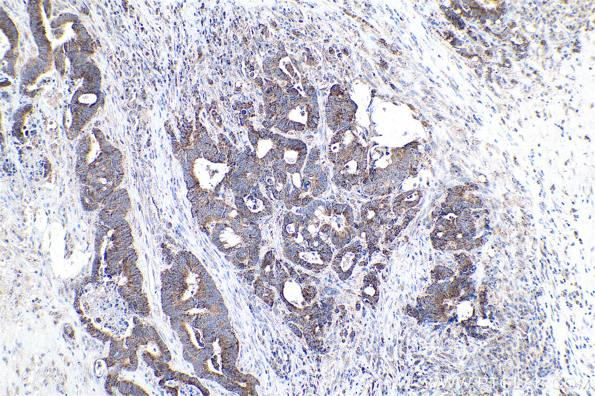 Immunohistochemical analysis of paraffin-embedded human colon cancer tissue slide using KHC0804 (MMP1 IHC Kit).