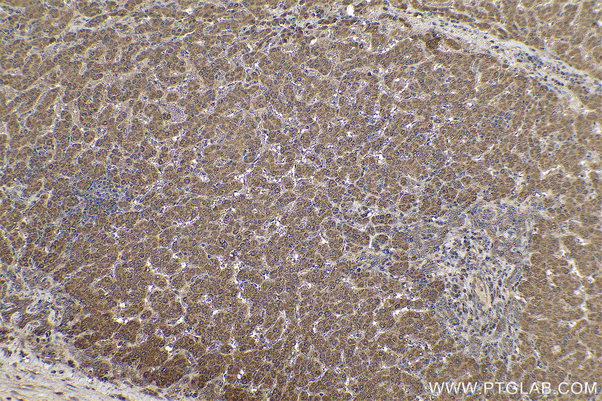 Immunohistochemical analysis of paraffin-embedded human liver cancer tissue slide using KHC0785 (MMP12 IHC Kit).