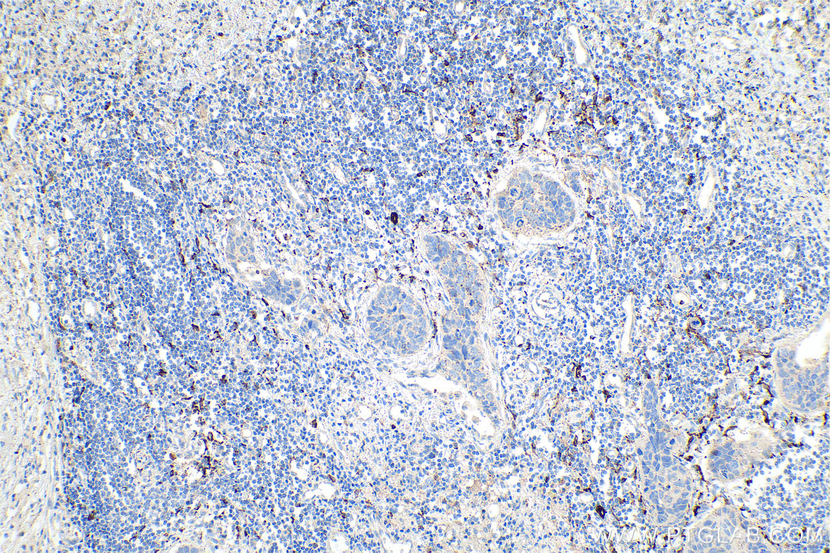 Immunohistochemical analysis of paraffin-embedded human lung cancer tissue slide using KHC0120 (MMP9 IHC Kit).