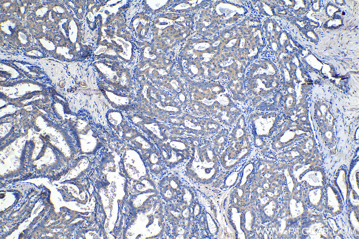 Immunohistochemical analysis of paraffin-embedded human breast cancer tissue slide using KHC1401 (MOAP1 IHC Kit).