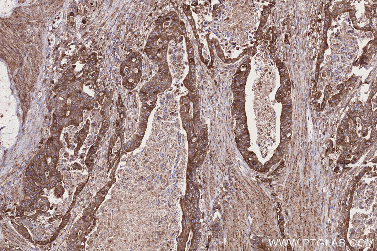 Immunohistochemical analysis of paraffin-embedded human stomach cancer tissue slide using KHC2700 (MOSPD2 IHC Kit).
