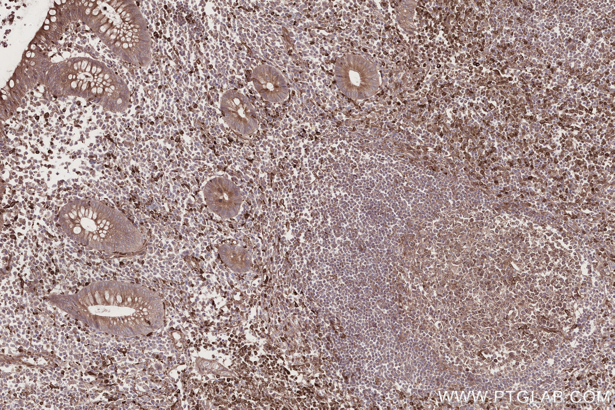 Immunohistochemical analysis of paraffin-embedded human appendicitis tissue slide using KHC2700 (MOSPD2 IHC Kit).