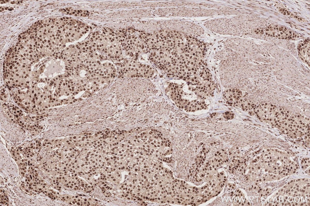 Immunohistochemical analysis of paraffin-embedded human stomach cancer tissue slide using KHC2841 (MPHOSPH6 IHC Kit).