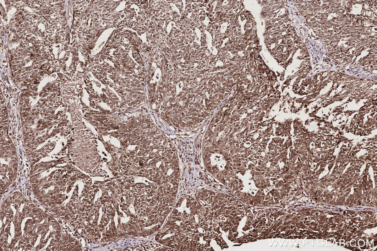 Immunohistochemical analysis of paraffin-embedded human ovary cancer tissue slide using KHC2706 (MPLKIP/TTDN1 IHC Kit).