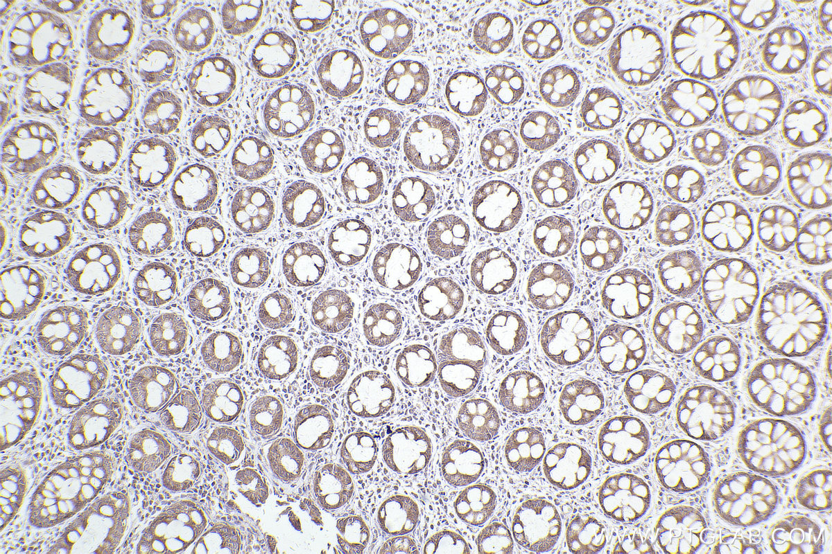 Immunohistochemical analysis of paraffin-embedded human rectal cancer tissue slide using KHC2551 (MPP7 IHC Kit).