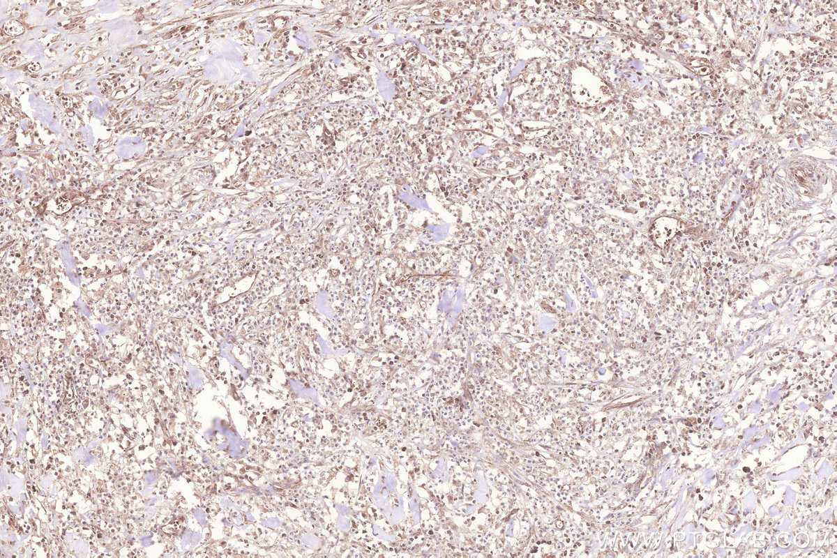 Immunohistochemical analysis of paraffin-embedded human colon cancer tissue slide using KHC3256 (MRPL23 IHC Kit).