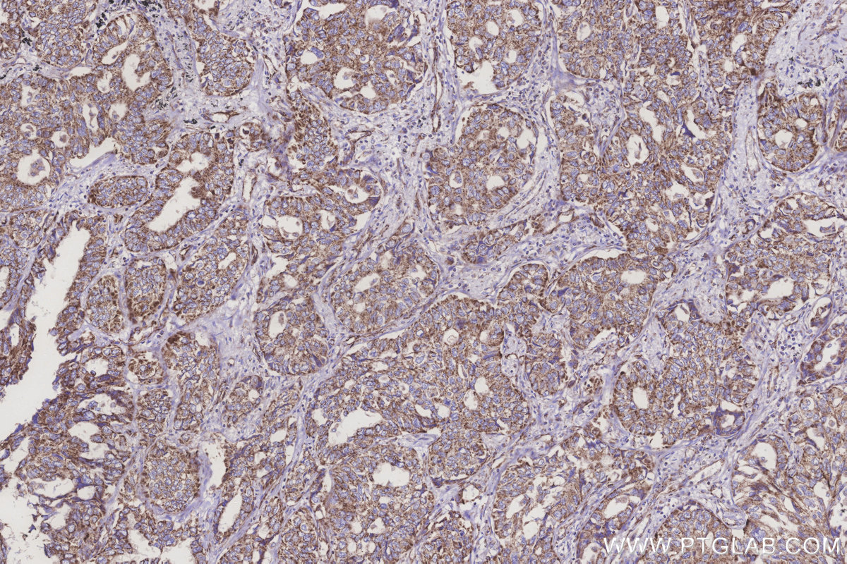 Immunohistochemical analysis of paraffin-embedded human lung cancer tissue slide using KHC3249 (MRPL28 IHC Kit).