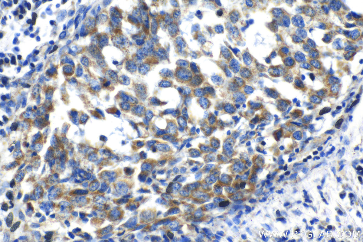 Immunohistochemical analysis of paraffin-embedded human breast cancer tissue slide using KHC1408 (MRPL42 IHC Kit).