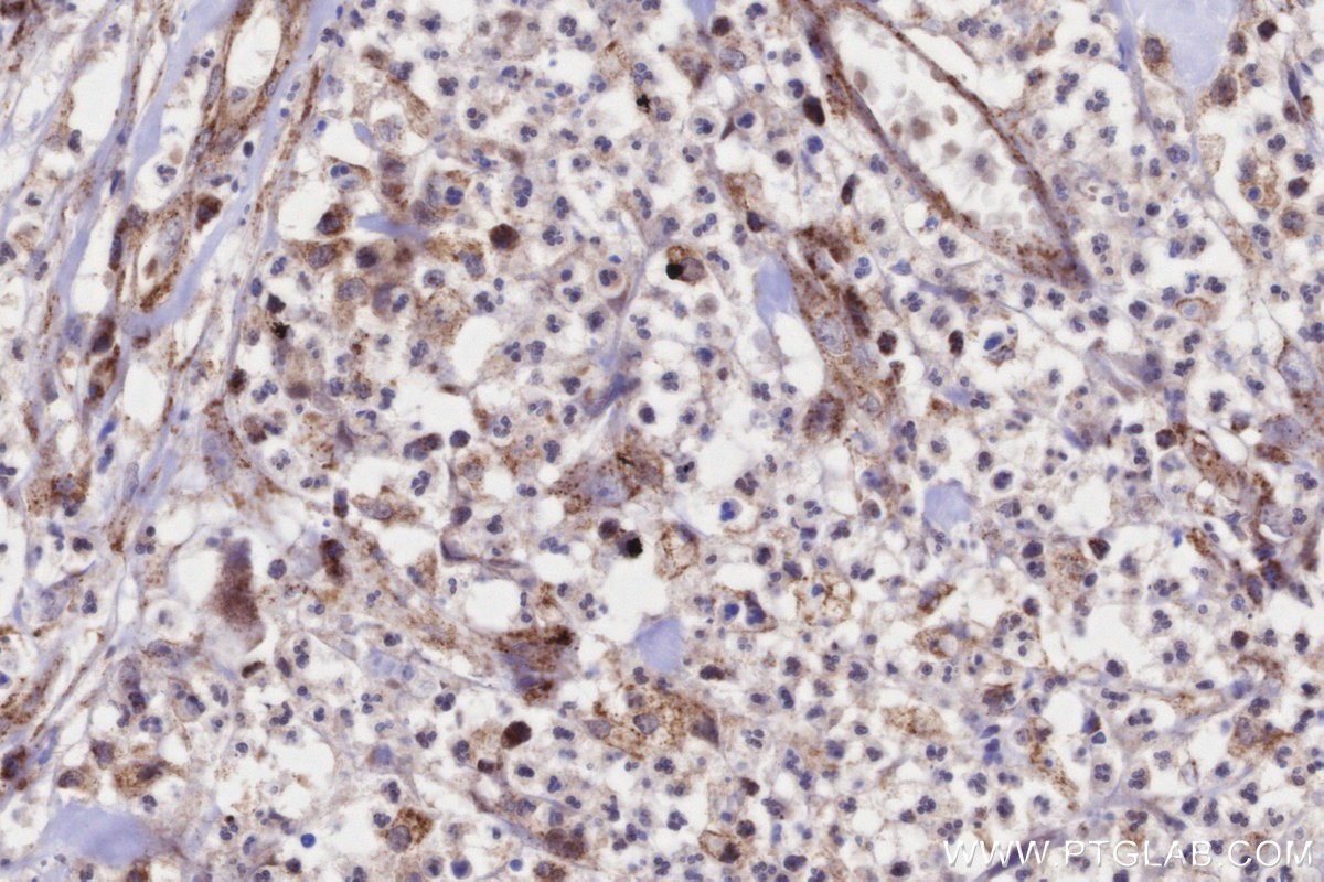 Immunohistochemical analysis of paraffin-embedded human colon cancer tissue slide using KHC3239 (MRPS22 IHC Kit).