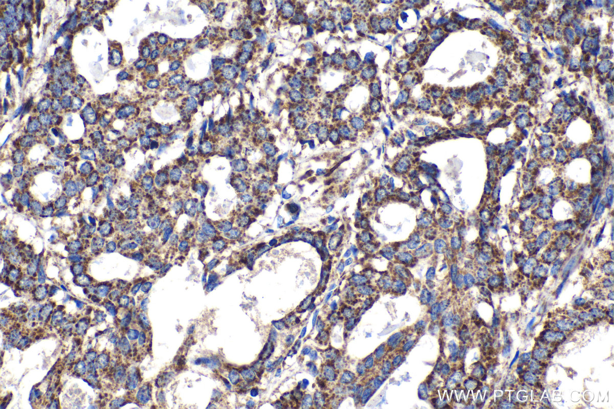 Immunohistochemical analysis of paraffin-embedded human breast cancer tissue slide using KHC1380 (MRPS34 IHC Kit).