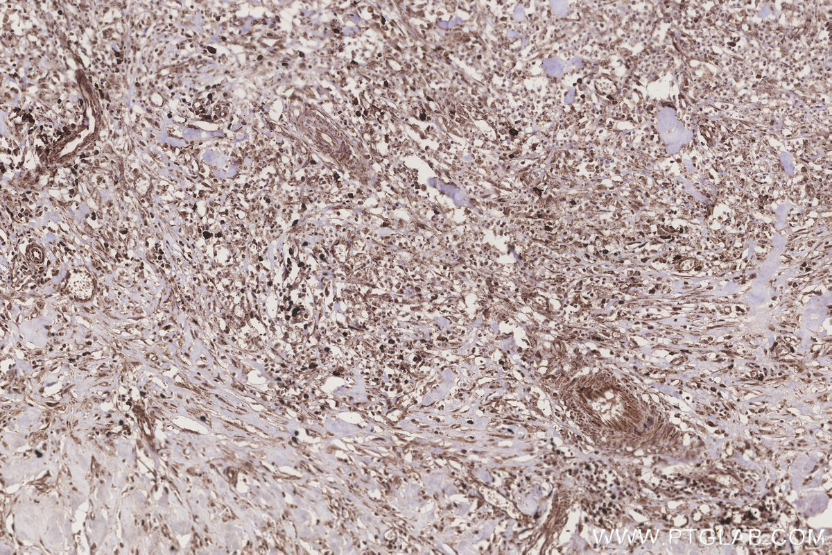 Immunohistochemical analysis of paraffin-embedded human colon cancer tissue slide using KHC3240 (MRPS35 IHC Kit).