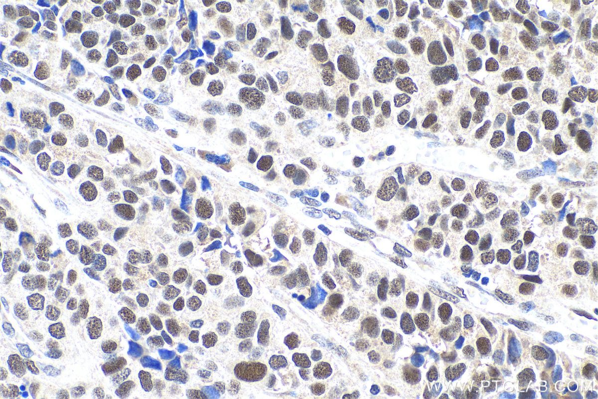 Immunohistochemical analysis of paraffin-embedded human stomach cancer tissue slide using KHC0733 (MSH6 IHC Kit).