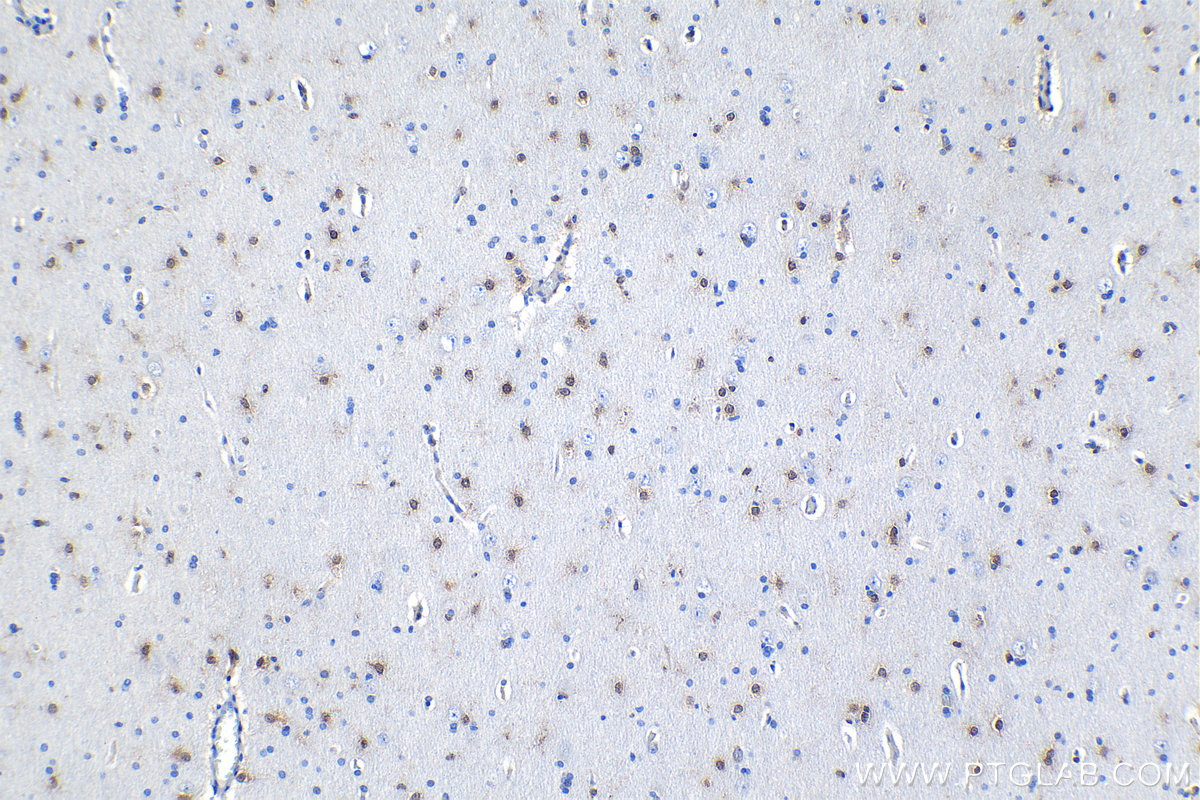 Immunohistochemical analysis of paraffin-embedded human gliomas tissue slide using KHC1211 (MSI1 IHC Kit).