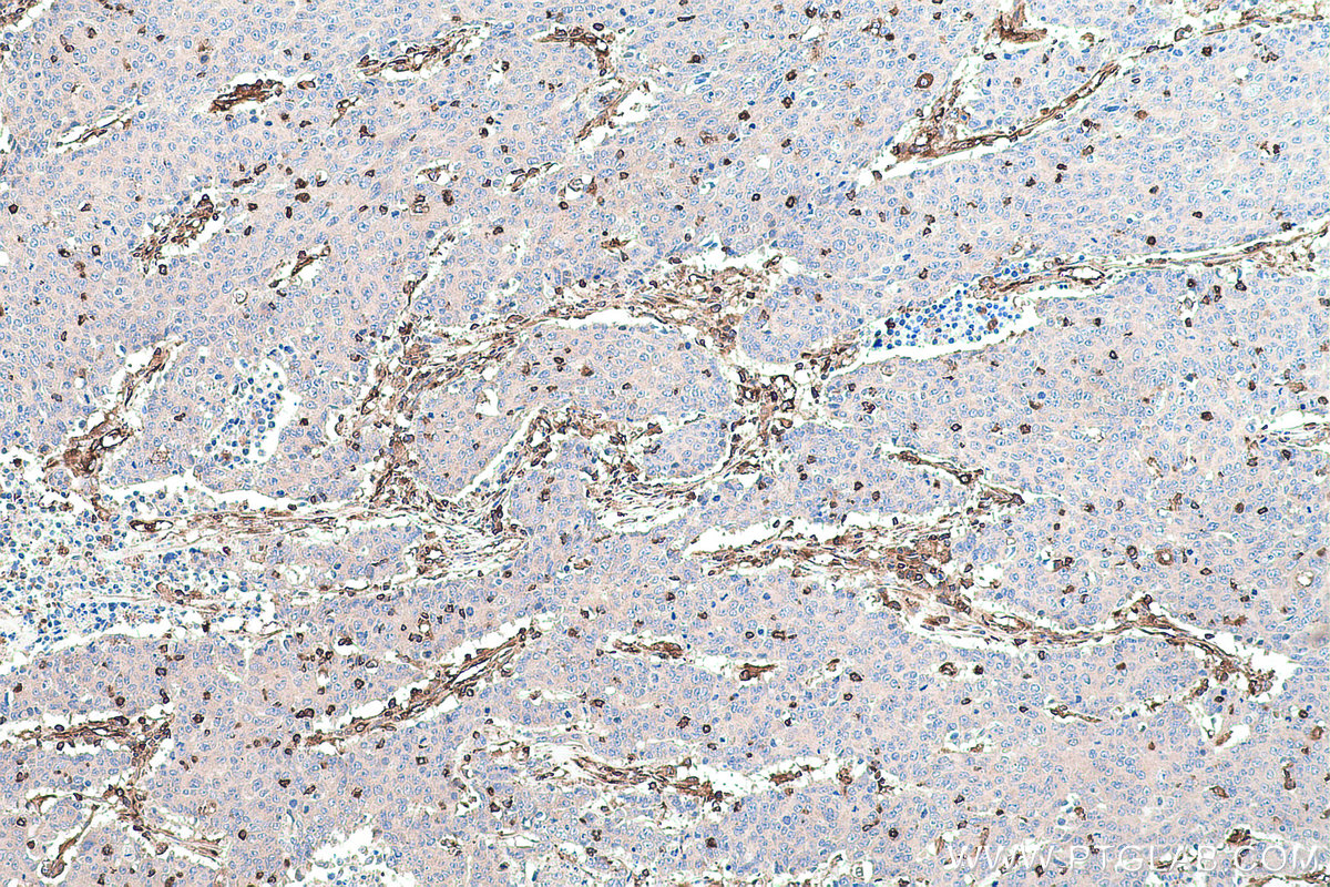 Immunohistochemical analysis of paraffin-embedded human colon cancer tissue slide using KHC0664 (MSN IHC Kit).