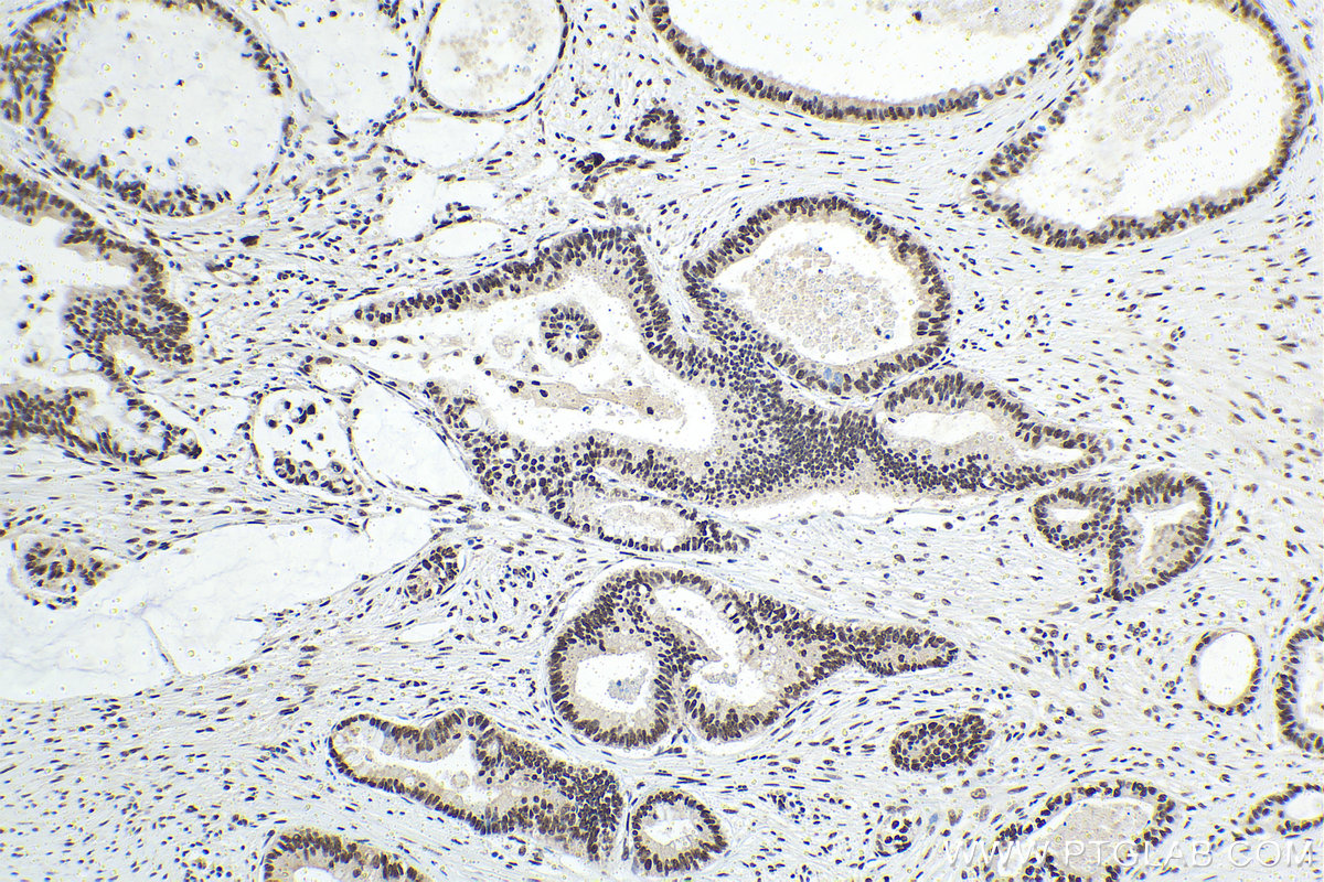 Immunohistochemical analysis of paraffin-embedded human pancreas cancer tissue slide using KHC1481 (MTA2 IHC Kit).