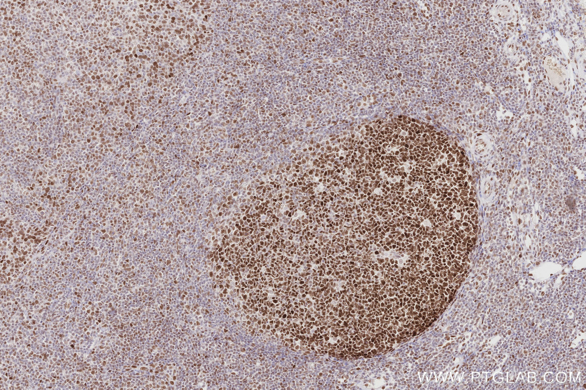 Immunohistochemical analysis of paraffin-embedded human tonsillitis tissue slide using KHC2865 (MTA3 IHC Kit).