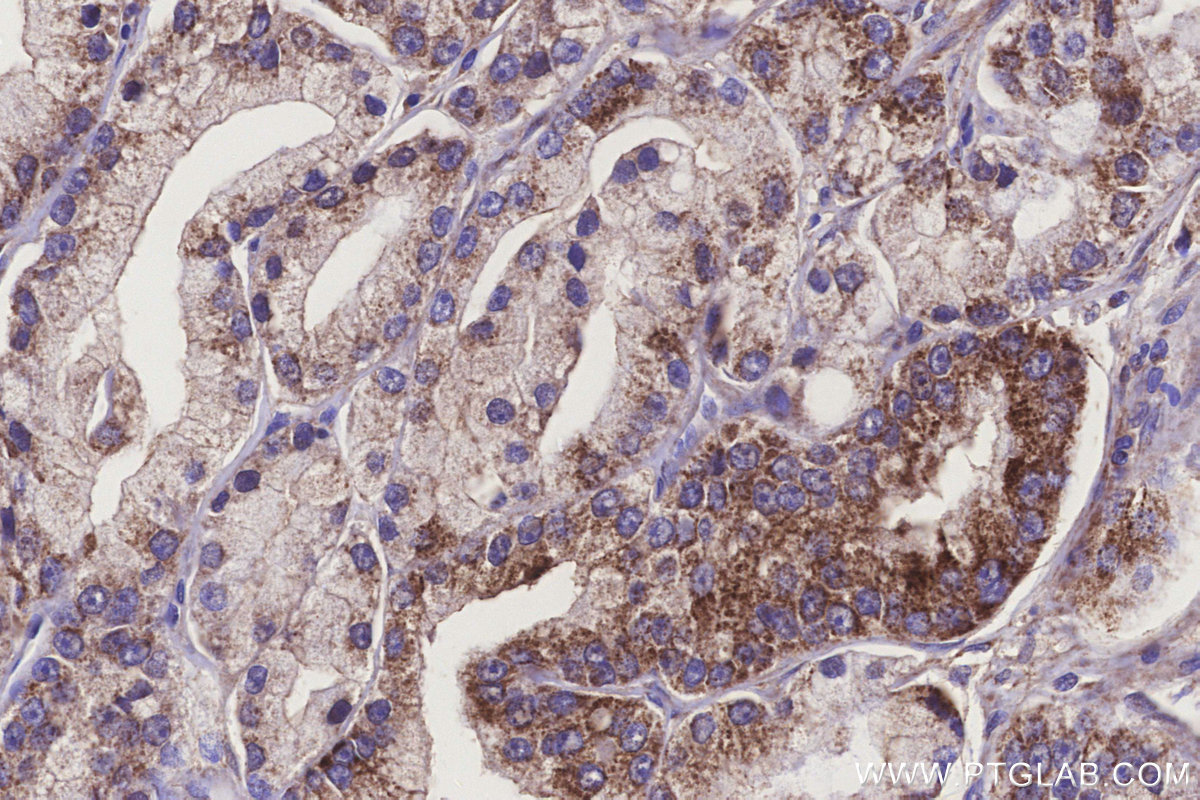 Immunohistochemical analysis of paraffin-embedded human prostate cancer tissue slide using KHC3265 (MTARC1/MOSC1 IHC Kit). Immunohistochemical analysis of paraffin-embedded human prostate cancer tissue slide using KHC3265 (MTARC1/MOSC1 IHC Kit).