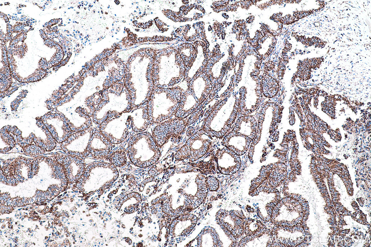 Immunohistochemical analysis of paraffin-embedded human ovary tumor tissue slide using KHC0575 (MTCO2 IHC Kit).