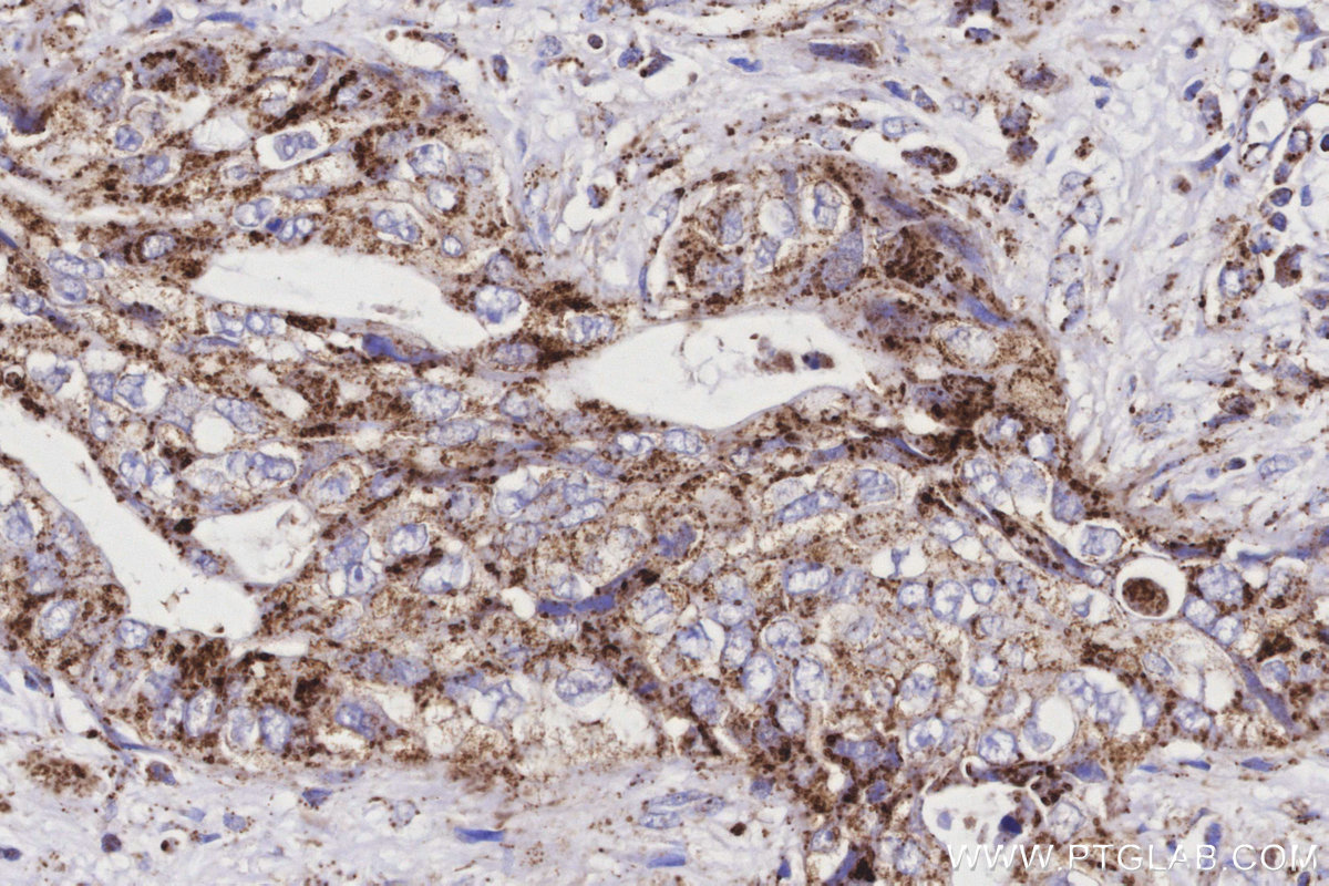 Immunohistochemical analysis of paraffin-embedded human pancreas cancer tissue slide using KHC3160 (MTCO3 IHC Kit). Immunohistochemical analysis of paraffin-embedded human pancreas cancer tissue slide using KHC3160 (MTCO3 IHC Kit).