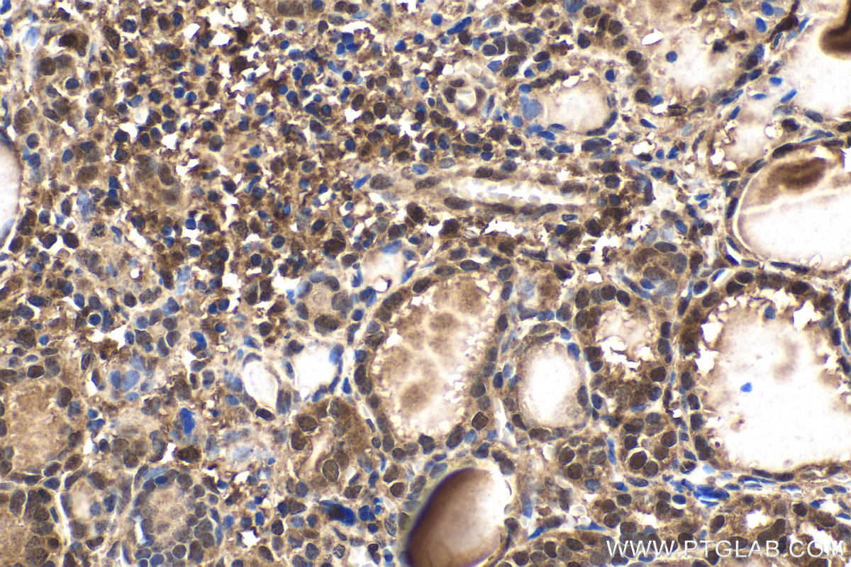 Immunohistochemical analysis of paraffin-embedded human thyroid cancer tissue slide using KHC1635 (MTPN IHC Kit).