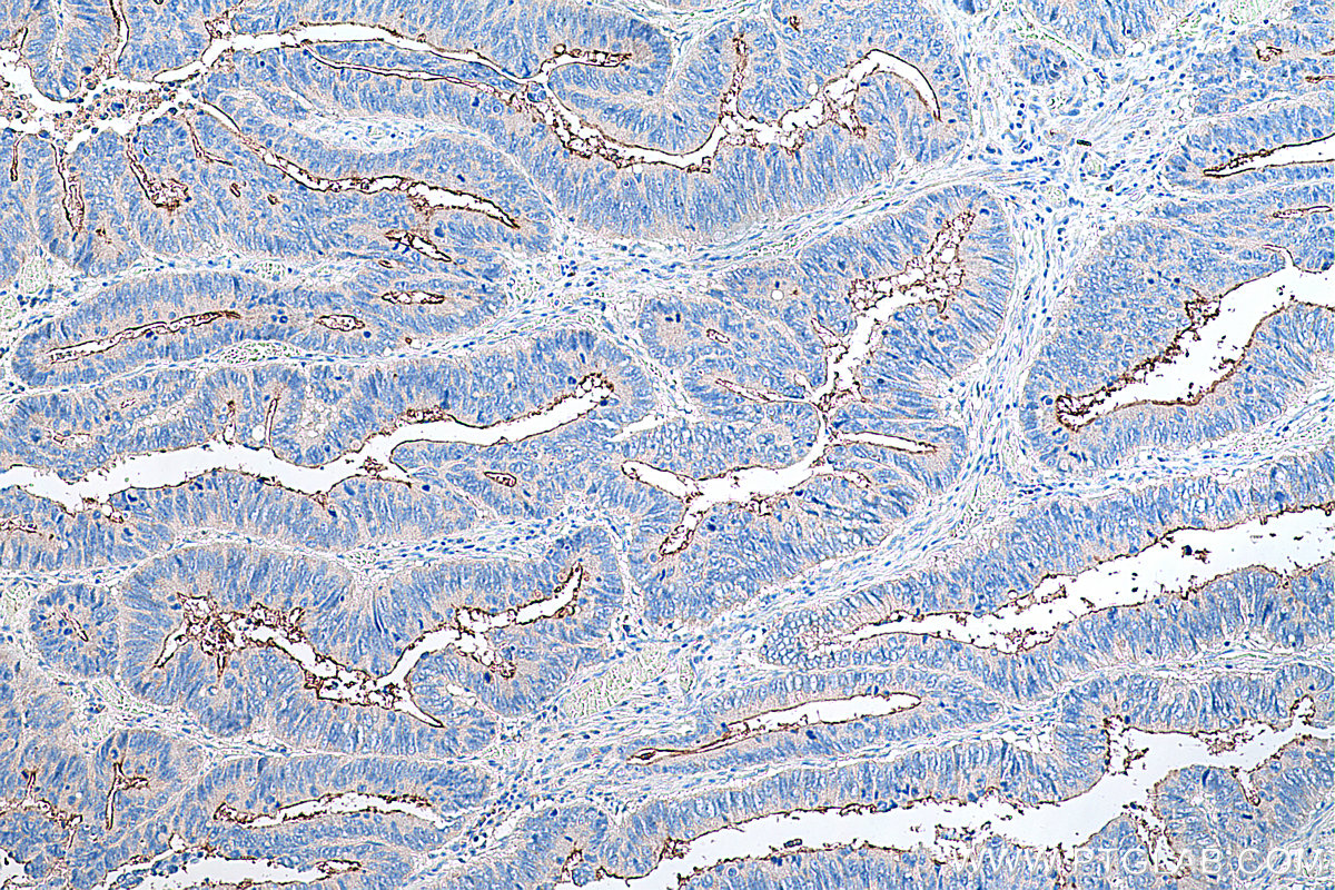 Immunohistochemical analysis of paraffin-embedded human colon cancer tissue slide using KHC0304 (MUC1 IHC Kit).