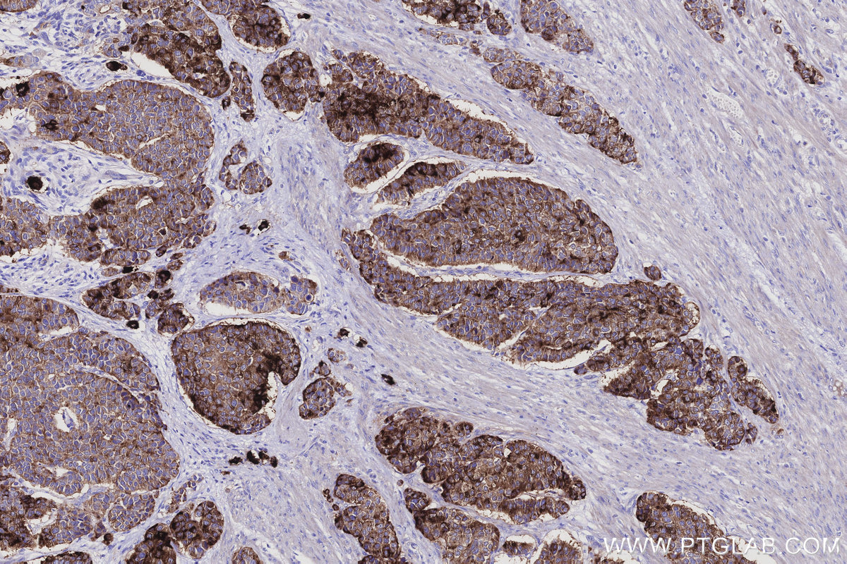 Immunohistochemical analysis of paraffin-embedded human stomach cancer tissue slide using KHC2912 (MUC13 IHC Kit).