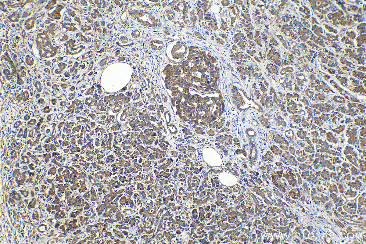 Immunohistochemical analysis of paraffin-embedded human pancreas cancer tissue slide using KHC1327 (MUC2 IHC Kit).