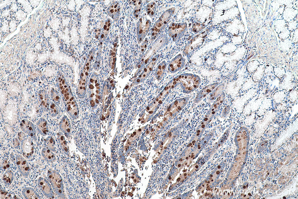 Immunohistochemical analysis of paraffin-embedded human stomach cancer tissue slide using KHC0603 (MUC4 IHC Kit).