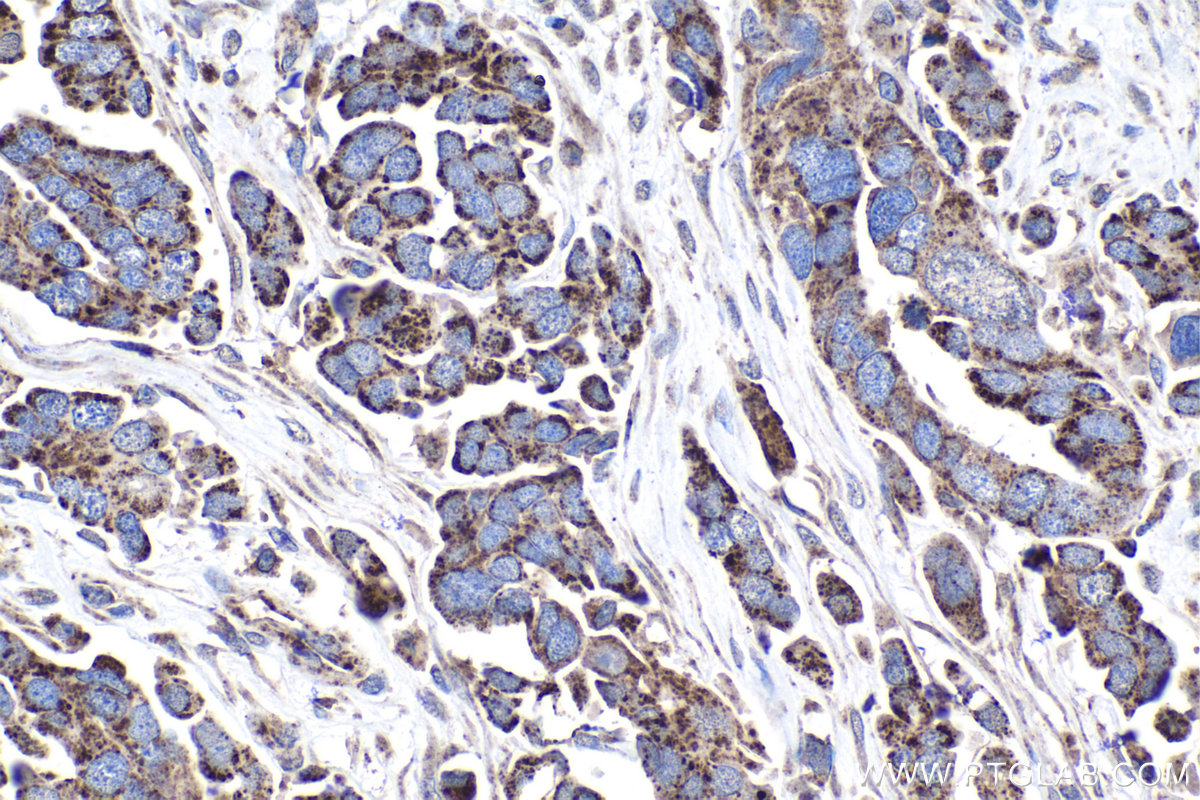 Immunohistochemical analysis of paraffin-embedded human colon cancer tissue slide using KHC1021 (MUT IHC Kit).