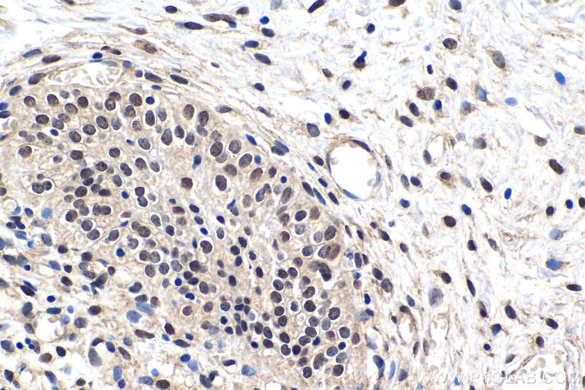 Immunohistochemical analysis of paraffin-embedded human urothelial carcinoma tissue slide using KHC1520 (MYBL2 IHC Kit).