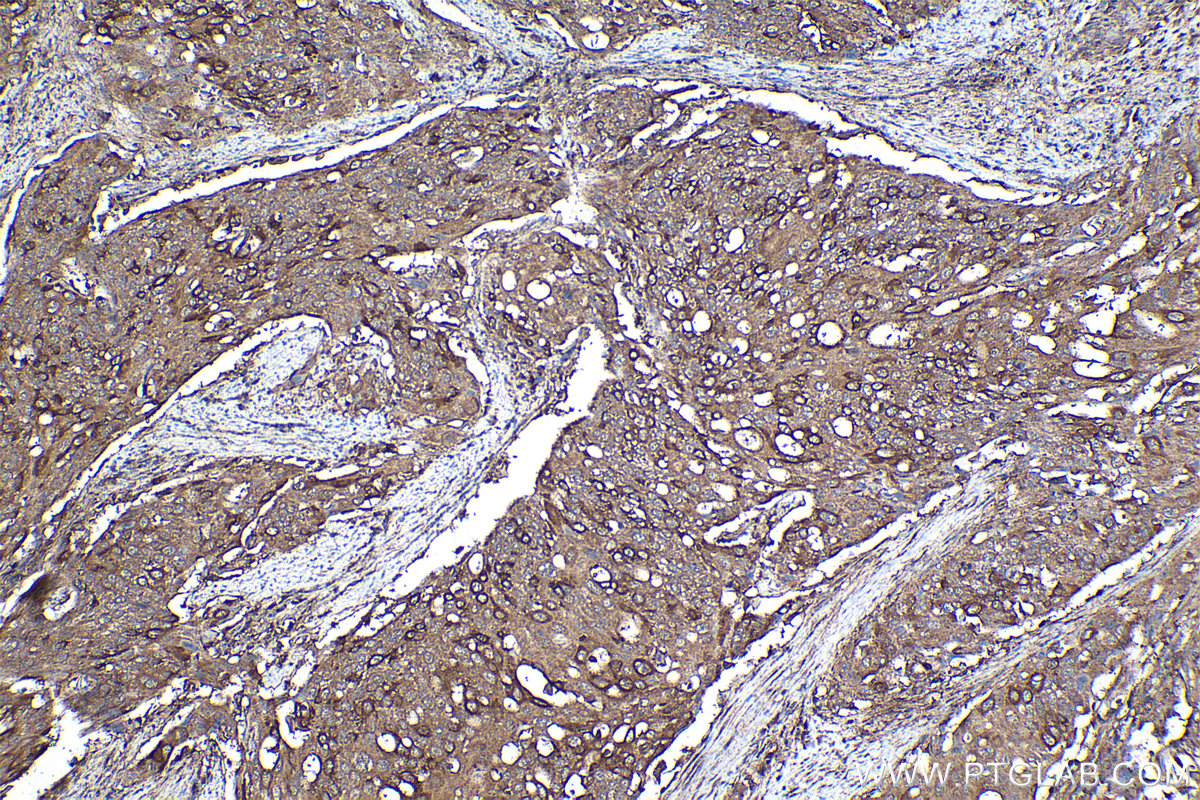 Immunohistochemical analysis of paraffin-embedded human cervical cancer tissue slide using KHC2116 (MYCBP2 IHC Kit).
