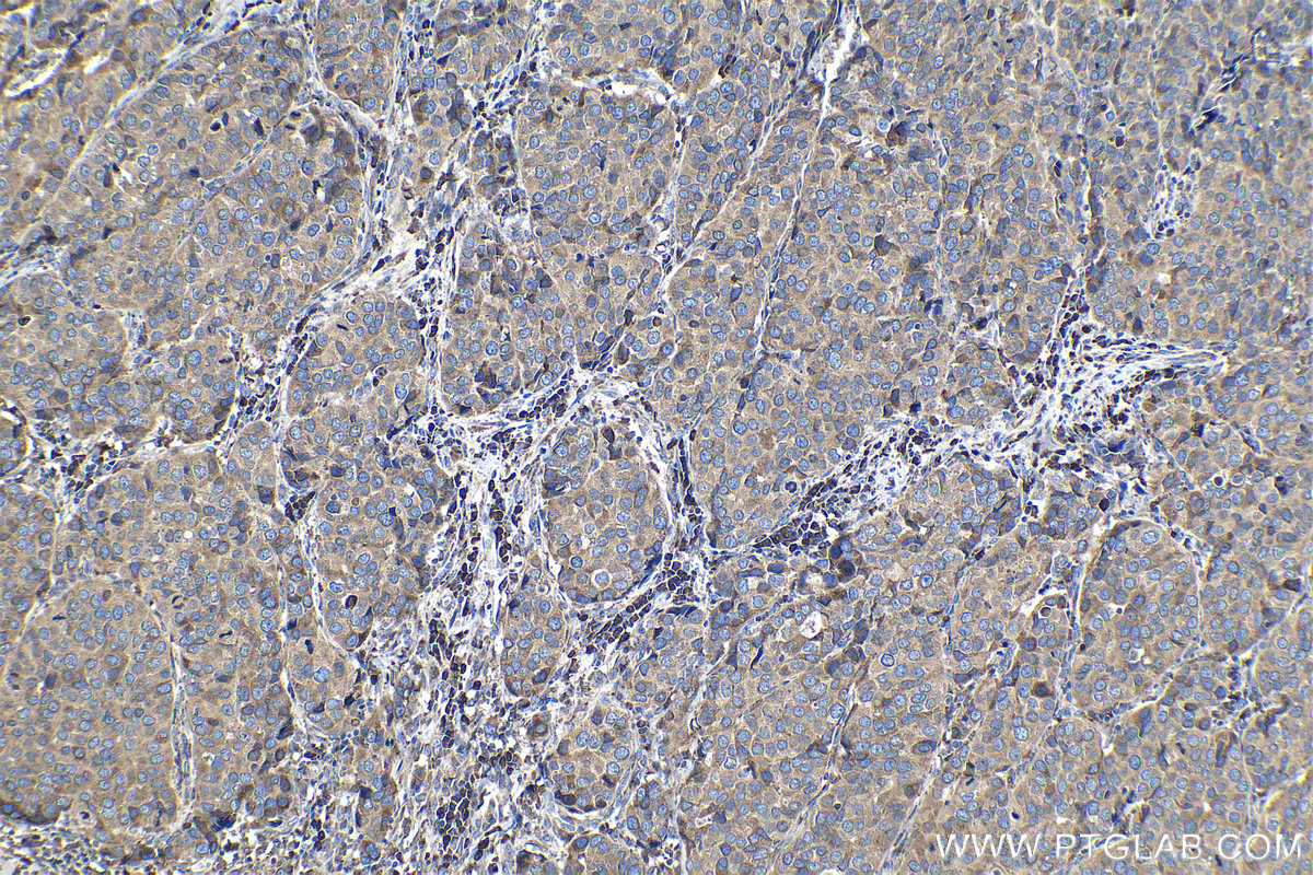 Immunohistochemical analysis of paraffin-embedded human stomach cancer tissue slide using KHC1139 (MYDGF IHC Kit).